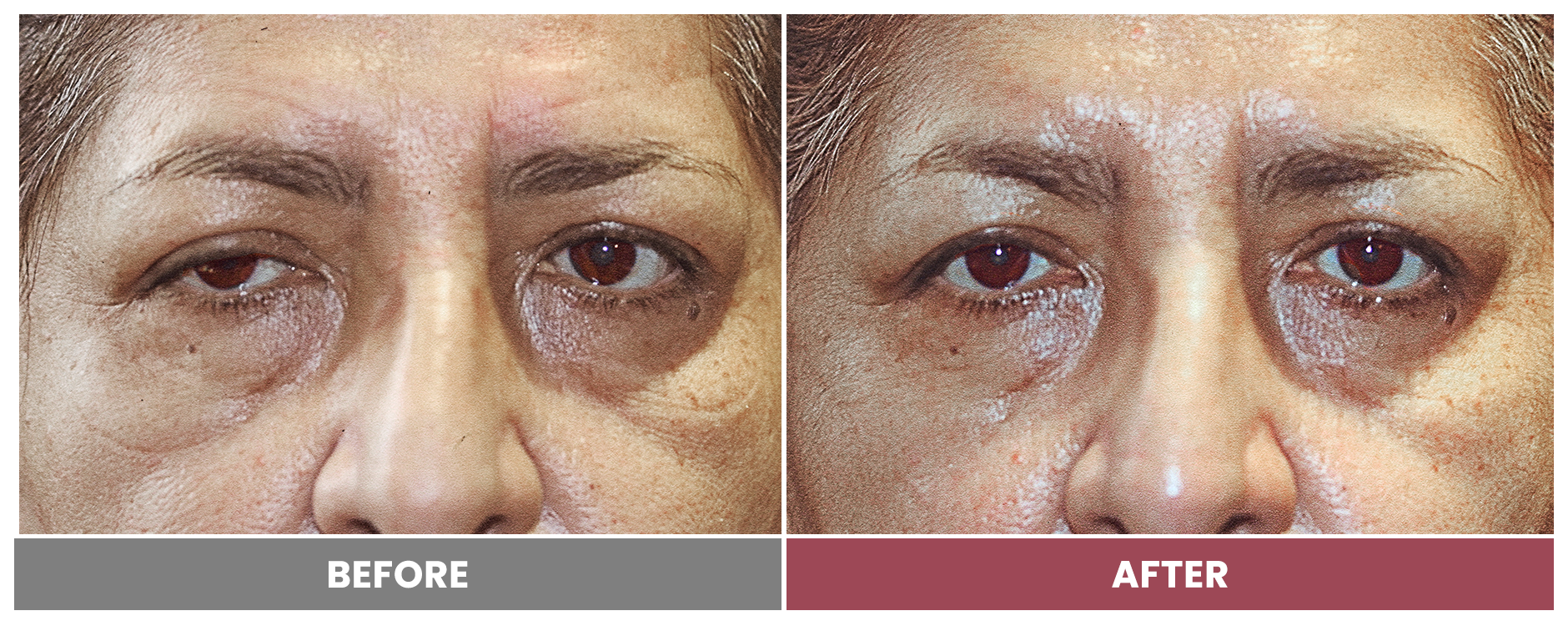PTOSIS REPAIR - Case 59